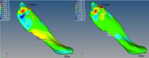 Figure 4b: Tensile strain in ACL upon 3g loading at 30 (left) and 45 (right) flexion angles