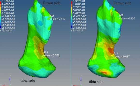 Figure 5a: Tensile strain in ACL for homogeneous (left) and heterogeneous cartilage (right) upon 3g loading